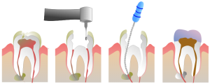 Root Canal Illustration 300x120 1