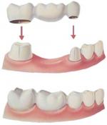 nugentdental bridge